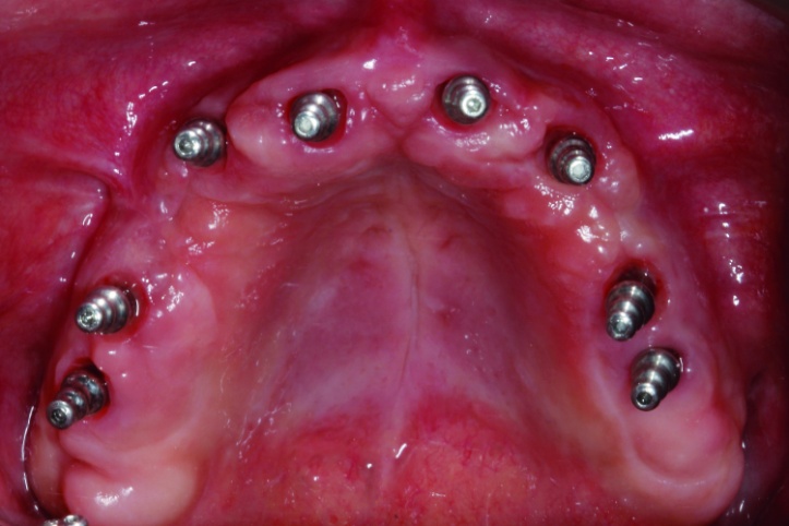 The use of CBCT and CAD/CAM techniques in complex implant-supported ...