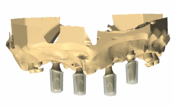 The use of CBCT and CAD/CAM techniques in complex implant-supported ...