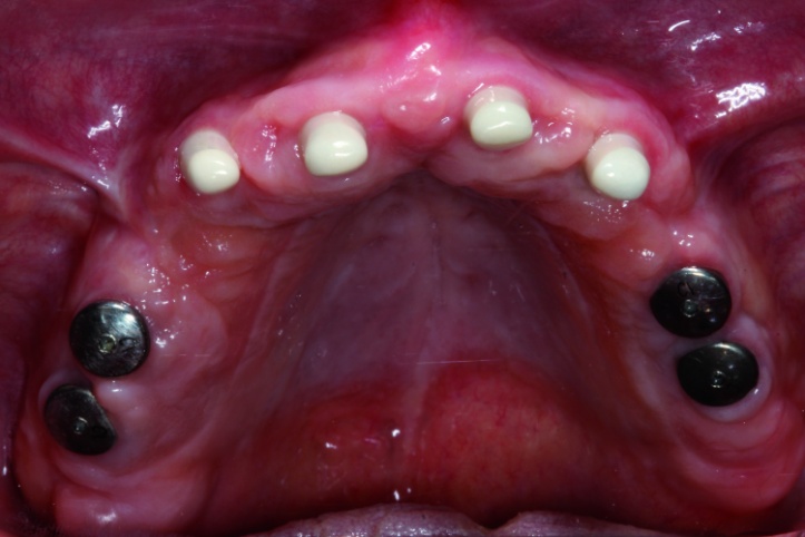 The use of CBCT and CAD/CAM techniques in complex implant-supported ...